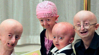 ¿Qué es la progeria? Síndrome poco común y envejecimiento acelerado que sorprende a todos