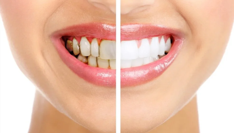 Por qué se amarillean los dientes y cómo prevenirlo