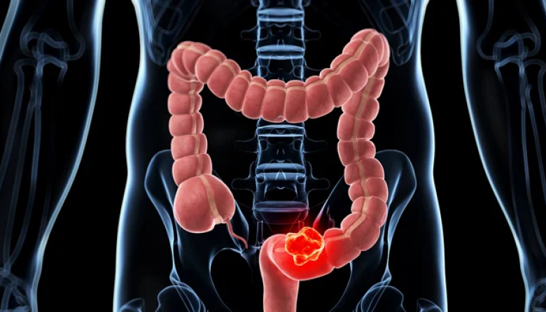 Detectar cáncer de colon a tiempo reduce casos graves