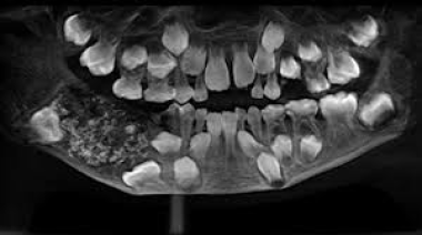 Niño en India tenía 526 dientes y fue operado con éxito