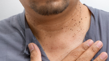 ¿Cómo quitar las verrugas del cuello de forma segura?
