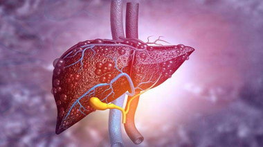 Diabetes tipo 2 y hígado graso: cómo detectarlo y prevenir complicaciones