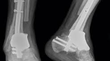 Pistola 3D permite imprimir huesos durante la cirugía