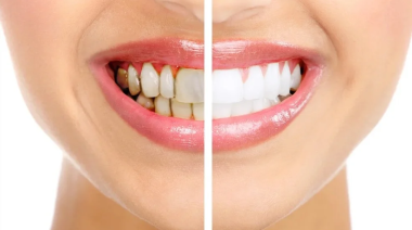 Por qué se amarillean los dientes y cómo prevenirlo