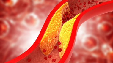 Colesterol alto: el enemigo silencioso que afecta la salud cardiovascular