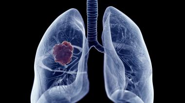 17 de Noviembre: Día de la Lucha contra el Cáncer de Pulmón una amenaza que avanza sin avisar