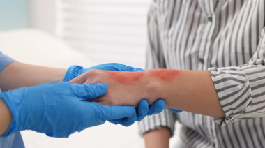 Qué hacer ante una quemadura y cuándo preocuparse