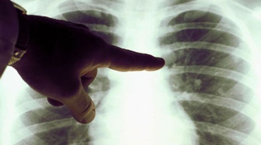 Cáncer en menores de 50: el informe que sacude a la salud internacional