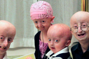 ¿Qué es la progeria? Síndrome poco común y envejecimiento acelerado que sorprende a todos