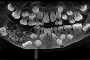 Niño en India tenía 526 dientes y fue operado con éxito