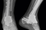 Pistola 3D permite imprimir huesos durante la cirugía