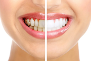 Por qué se amarillean los dientes y cómo prevenirlo