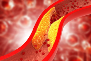 Colesterol alto: el enemigo silencioso que afecta la salud cardiovascular