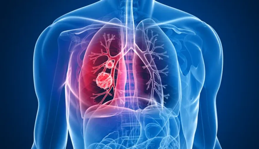Un tratamiento experimental abre una nueva esperanza para el cáncer de pulmón