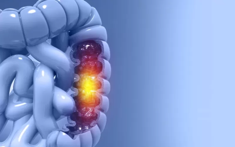 Cuida tu cuerpo: Tips para identificar los síntomas y detectar el cáncer de colon a tiempo